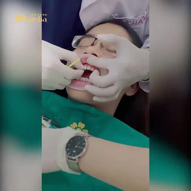 CẬN CẢNH DÁN SỨ VENEER KHÔNG MÀI NHỎ TẠI DELIA