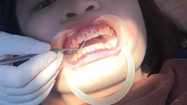 GẮN MẮC CÀI CHO KHÁCH  HÔ + KHẤP KHỂNH NHẸ