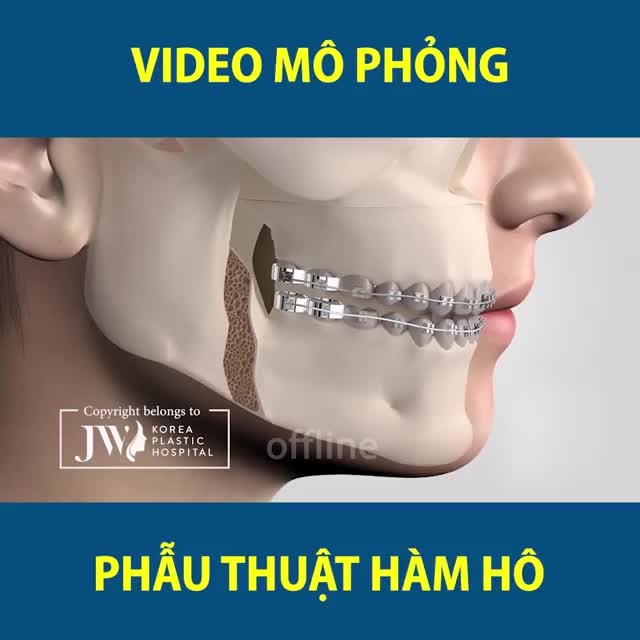 4. Ưu điểm của mô phỏng phẫu thuật hàm hô