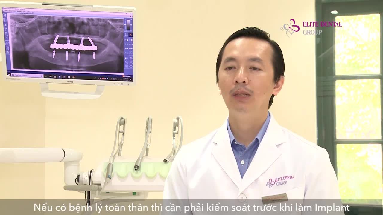 QUY TRÌNH TRỒNG RĂNG IMPLANT ALL-ON-4/PROARCH