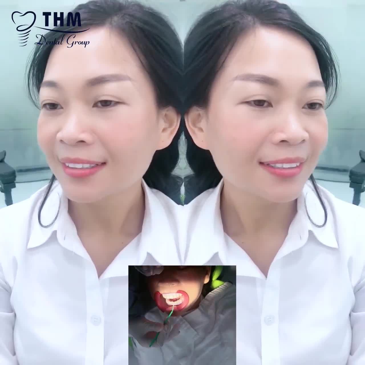 TẨY TRẮNG RĂNG – SỞ HỮU MỘT HÀM RĂNG TỰ NHIÊN TRẮNG SÁNG