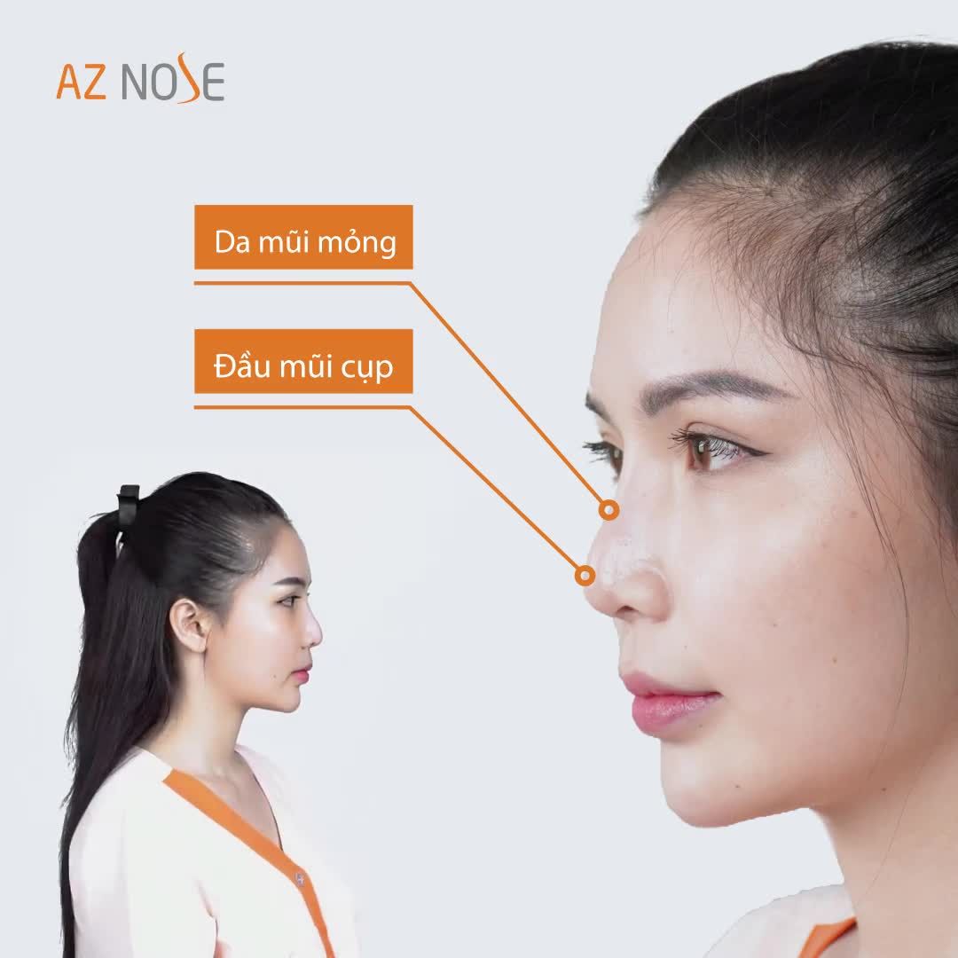 8 NGÀY SỞ HỮU FORM MŨI XUẤT SẮC