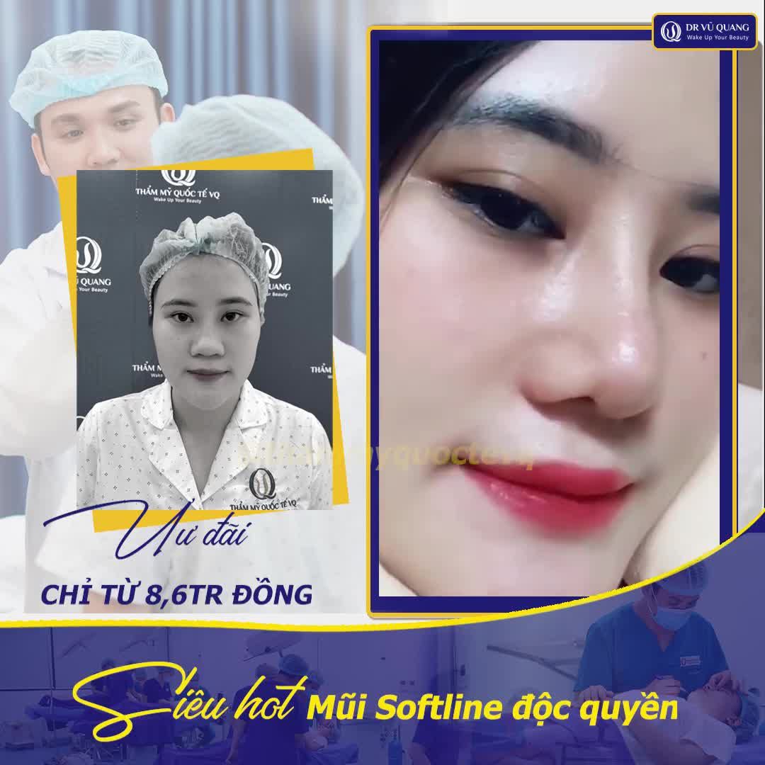 NÂNG MŨI SOFTLINE, BẠN ĐƯỢC NHỮNG GÌ ??