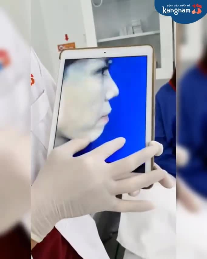 Quá hài lòng với CẮT MÍ, khách hàng "triển luôn" độn cằm V-line 3D