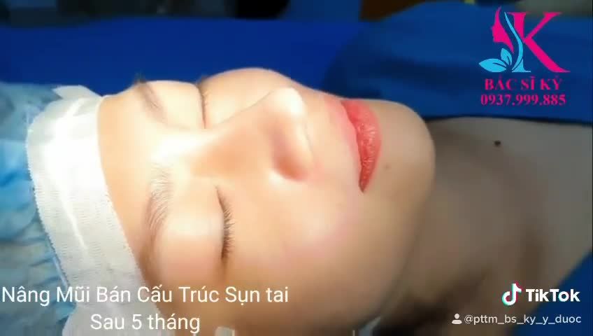 SAU 5 THÁNG NÂNG MŨI TẠIBÁC SĨ KỲ Y DƯỢC RA SAO