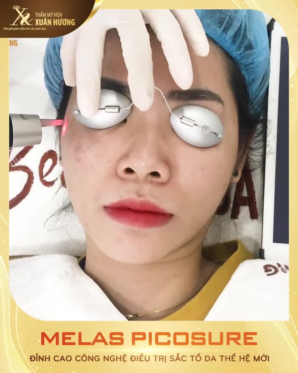 SỰ KHÁC BIỆT CỦA LÀN DA SAU KHI ĐIỀU TRỊ BỚT OTA BẰNG MELAS PICOSURE VẪN LÀ BẠN - NHƯNG ĐẸP HƠN, DA SÁNG MỊN KHÔNG CÒN "DẤU VẾT" CỦA CHÀM BỚT