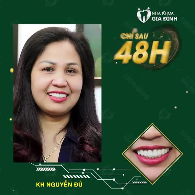HỒI XUÂN NỤ CƯỜI VỚI THẨM MỸ RĂNG SỨ