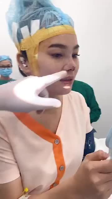 KÉO DÀI MŨI NGẮN HẾCH BẰNG PHƯƠNG PHÁP CẤU TRÚC