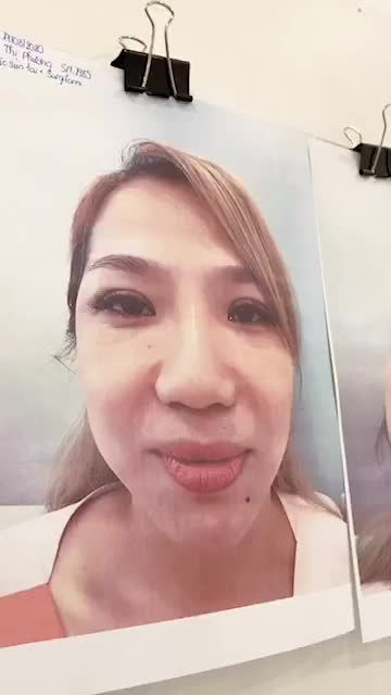 MŨI TO BÈ - ĐẦU MŨI CỤP DO SỬA MŨI HỎNG