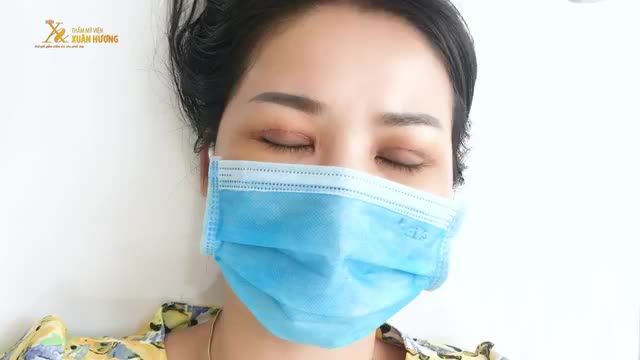 QUÁ TRÌNH CẮT CHỈ SAU 5 NGÀY CẮT MÍ TẠI TMV XUÂN HƯƠNG DIỄN RA NHƯ THẾ NÀO?