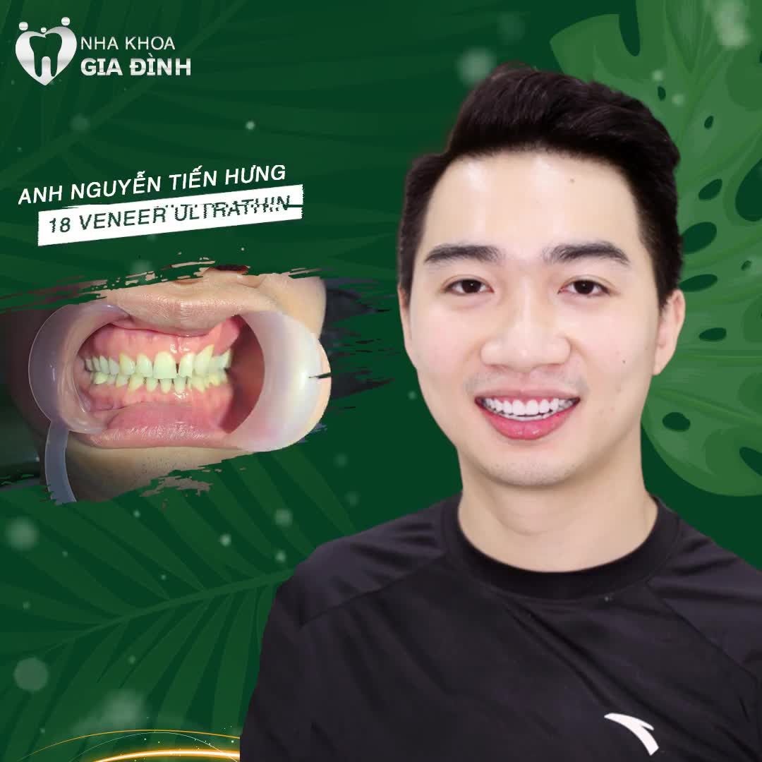 DÁN SỨ VENEER ƯU ĐÃI CHỈ TỪ 3TR/RĂNG -  BẢO HÀNH ĐẾN TRỌN ĐỜI