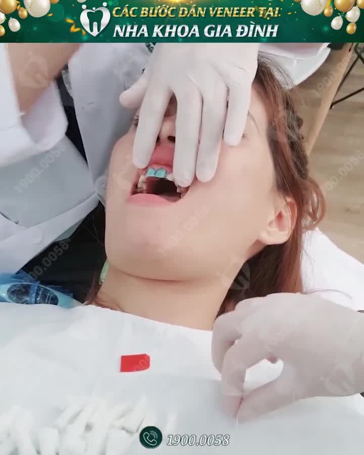 CẬN CẢNH DÁN SỨ VENEER KHÔNG MÀI NHỎ TẠI NHA KHOA GIA ĐÌNH