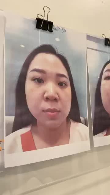 NÂNG MŨI KHÔNG ĐAU - KHẮC PHỤC KHUYẾT ĐIỂM MŨI THẤP TẸT