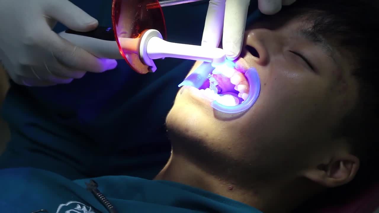 Niềng răng mắc cài truyền thống - an toàn