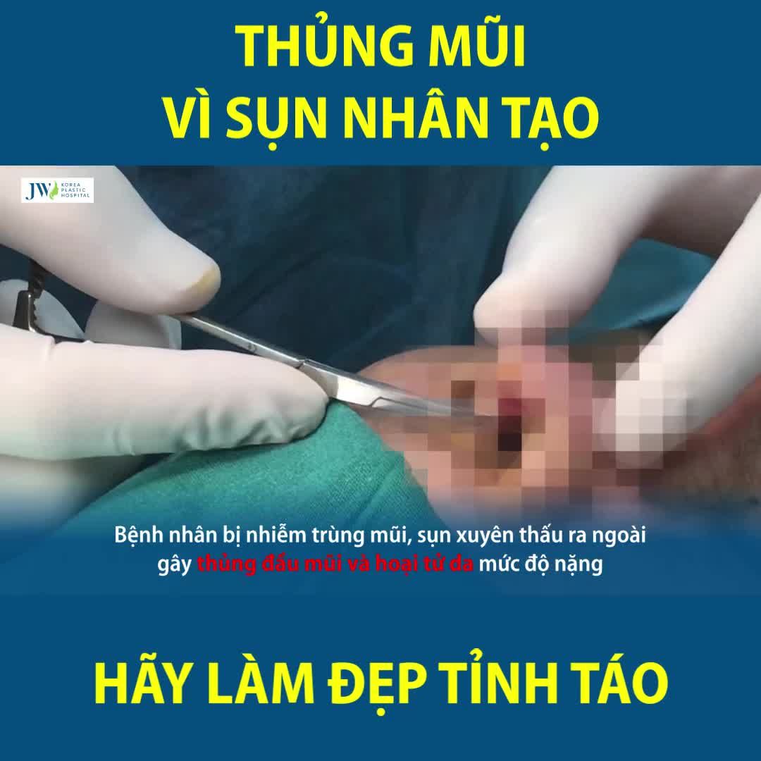 ĐẦU MŨI THỦNG LỖ TO NHƯ VIÊN BI DO NÂNG MŨI BẰNG SỤN NHÂN TẠO