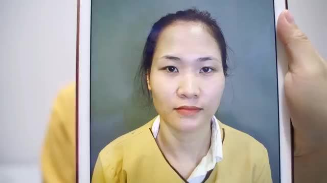 "Đến Dr.Hải Lê thấy nhiều bạn nâng mũi với làm mí em nghiện quá nên quyết định làm luôn 2 dv cùng lúc xem thế nào, ai ngờ được thay đổi quá trời"