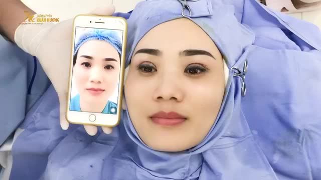 TRƯỜNG HỢP MÍ MẮT ĐẶC BIỆT: NẾP MÍ KHÔNG ĐỀU VÀ BỊ TRŨNG Ở PHẦN TRÊN MÍ, BÁC SĨ XỬ LÝ NHẸ NHÀNG SAU 30 PHÚT