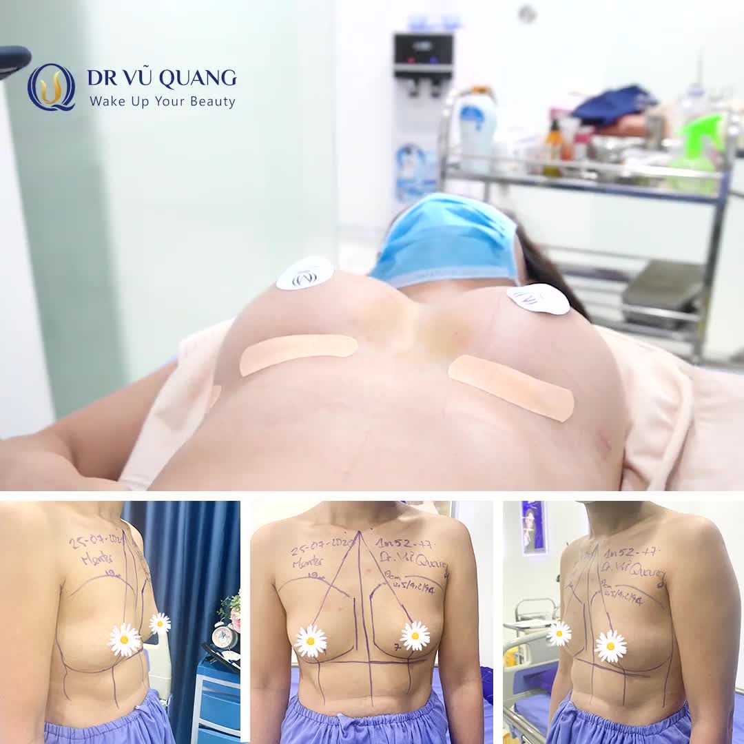 UPSIZE VÒNG 1 - THOÁT LÉP VĨNH VIỄN