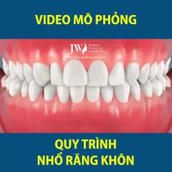 MÔ PHỎNG QUÁ TRÌNH NHỔ RĂNG KHÔN MỌC LỆCH