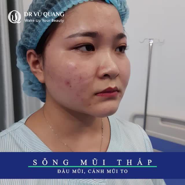 "Em rất la hài lòng, Bác sĩ rất là mát tay " - Là chia sẻ của khách hàng sau khi Nâng Mũi Softline + Cắt Mí Baby Eyes 6D 1 tháng tại VQ.