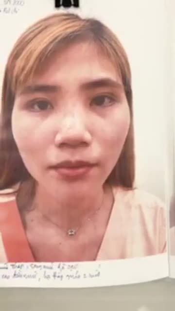 Khách hàng đã từng nâng mũi chỉ được 1 năm, sóng mũi thô, đầu mũi to, cánh mũi bè.