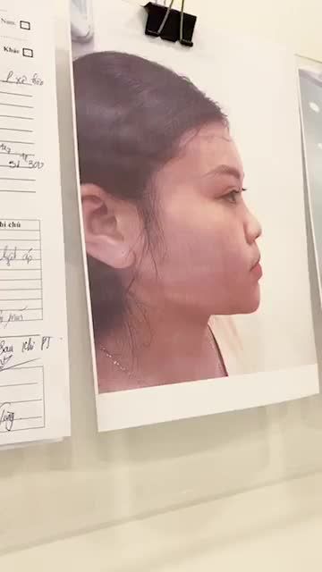 MŨI TO - ĐẦU MŨI NGẮN "HÓA XINH" SAU 90P NÂNG MŨI CẤU TRÚC NHẸ NHÀNG