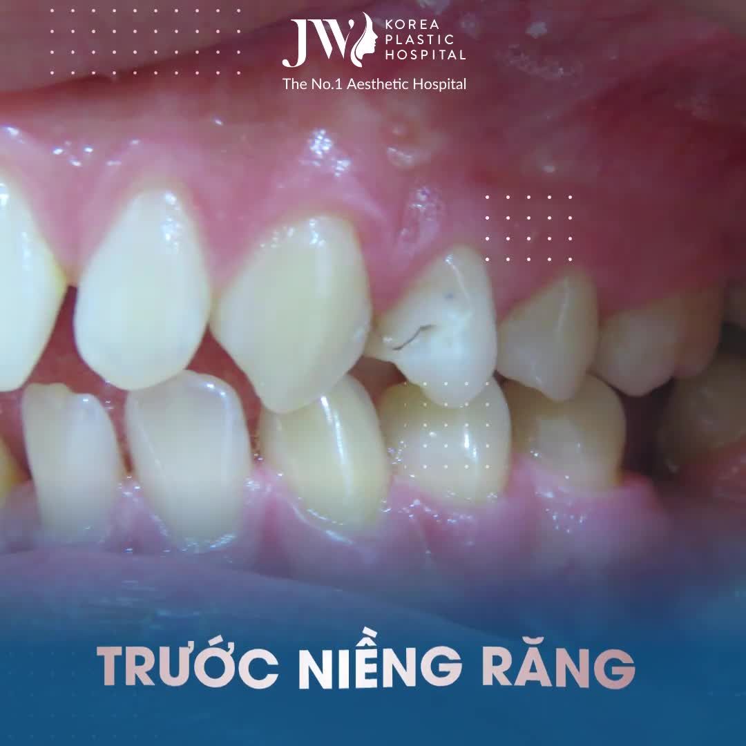 "NIỀNG RĂNG TẠI JW - EM TIN MÌNH SẼ CÓ ĐƯỢC NỤ CƯỜI ĐẸP"