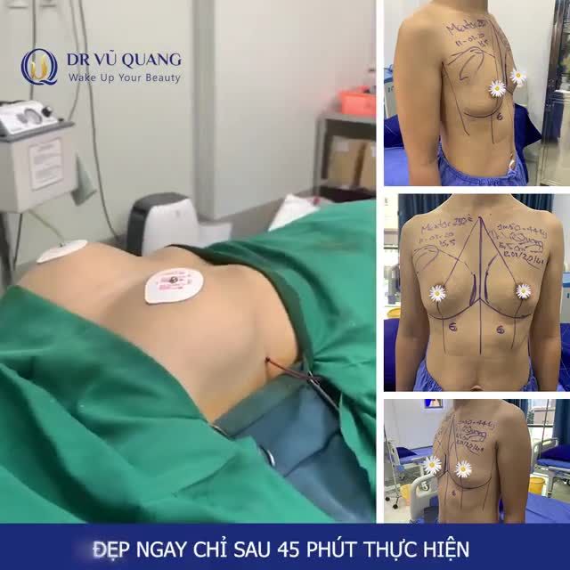 V1 CỦA BẠN SẼ NHƯ THẾ NÀO NGAY SAU KHI PHẪU THUẬT?