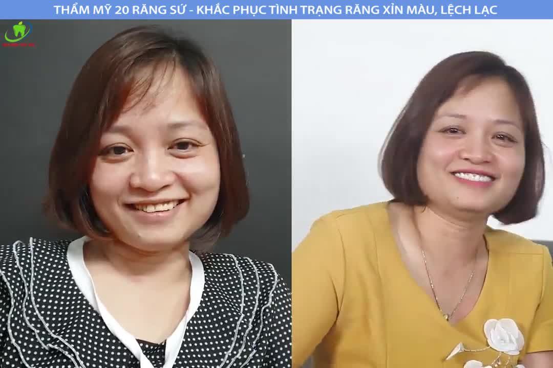 BỌC RĂNG SỨ THẨM MỸ - LƯU GIỮ NỤ CƯỜI THANH XUÂN