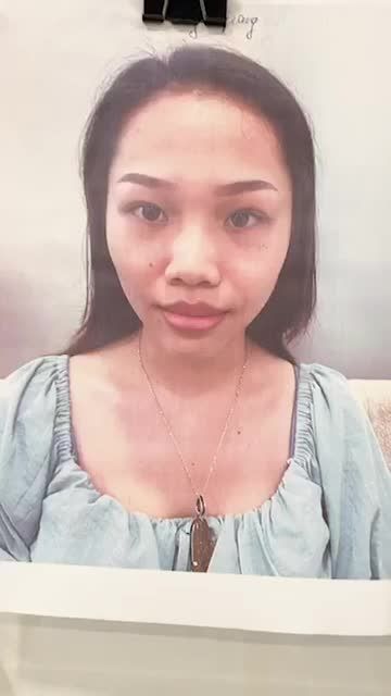 Kết quả sau hơn 2 tiếng phẫu thuật của khách hàng Hoàng Giang đây ạ!