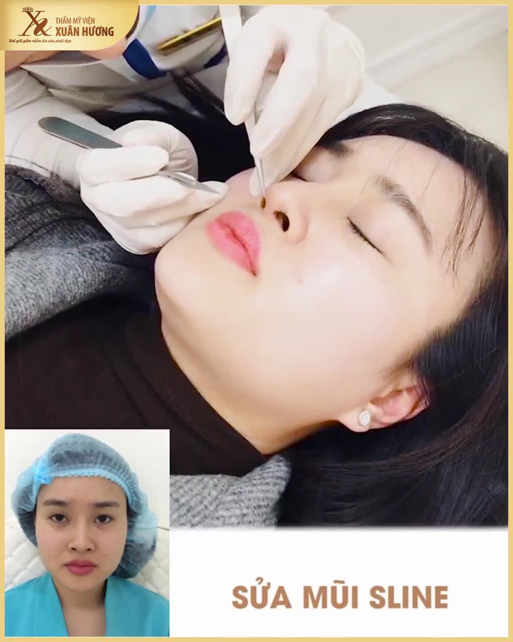 "GIẢI CỨU" MŨI CAN THIỆP HỎNG TẠI CƠ SỞ KHÔNG UY TÍN TMV XUÂN HƯƠNG TÁI TẠO DÁNG MŨI MỚI CAO SANG - ĐẸP AN TOÀN CHUẨN Y TẾ