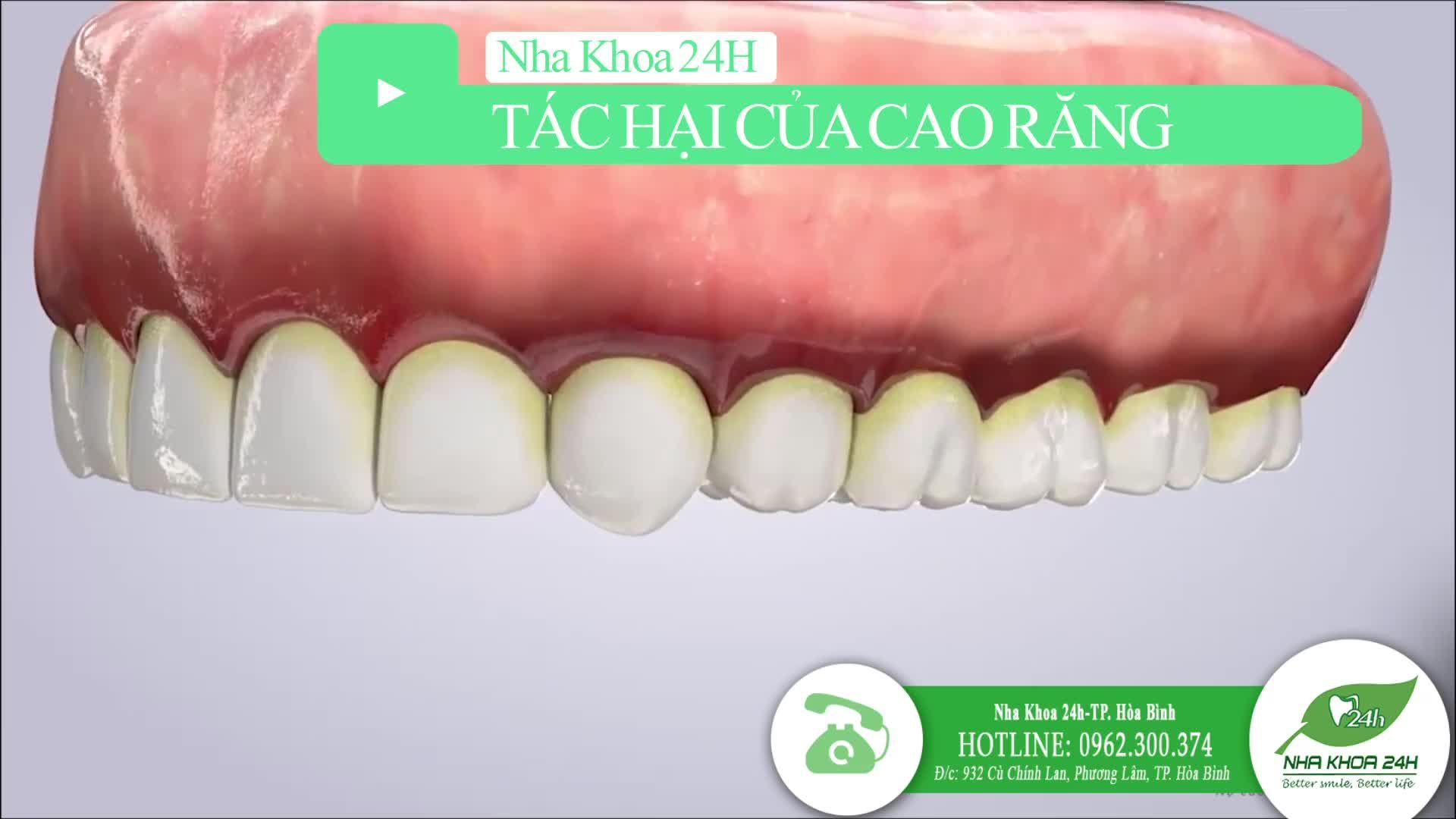 Mảng Bám Cao Răng Có Thể Gây Mất Răng