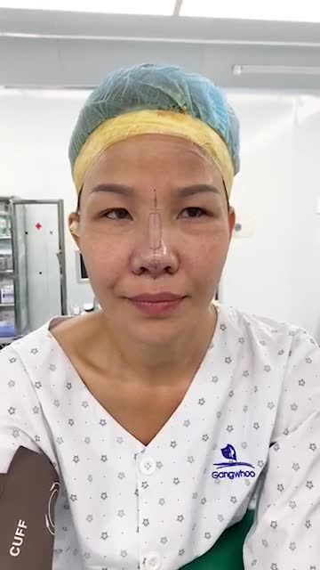Mũi bọc sụn gom cánh cực kì đẹp ngay sau khi làm