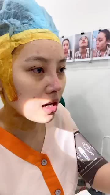 MŨI TO + NGẮN HẾCH CỰC ĐẸP SAU NÂNG MŨI CẤU TRÚC