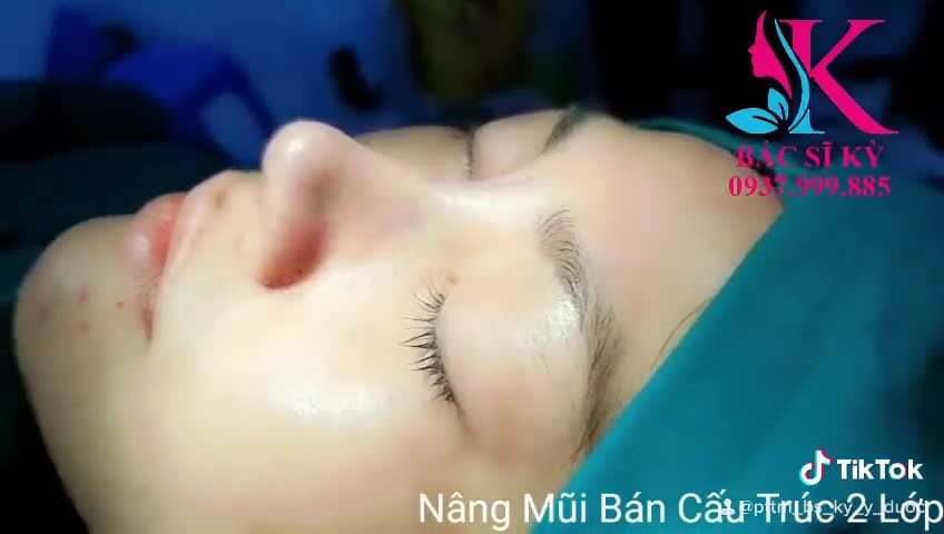 Nâng Mũi Bán Cấu Trúc Sụn Tai 2 Lớp