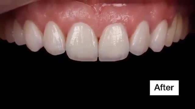 NÉT ĐẸP HIỆN ĐẠI , DÁNG RĂNG HIỆN ĐẠI - NỤ CƯỜI ĐẲNG CẤP TINH TẾ ĐẾN TỪ NHA KHOA  XS DENTAL