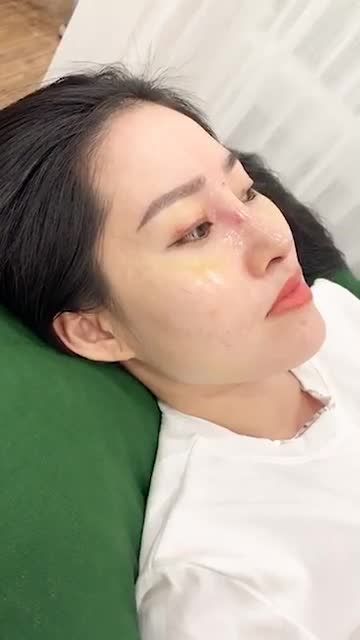 Tiếp tục một review vô cùng dễ thương của khách hàng sau khi nâng mũi mới vỏn vẹn 10 ngày tại Bác sĩ Đỗ Quang Khải.