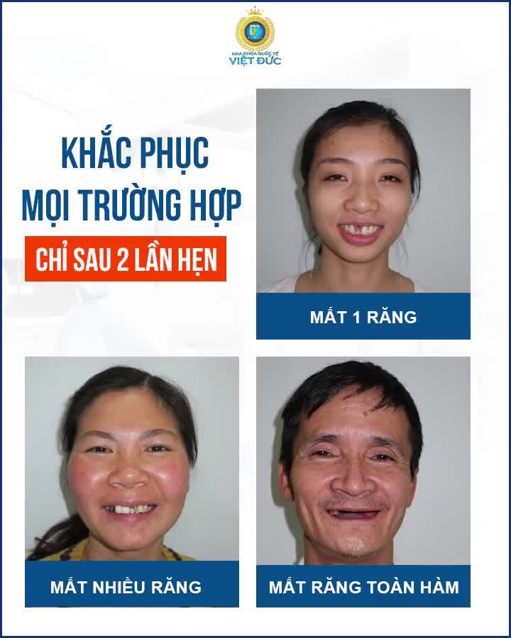 TRỒNG RĂNG IMPLANT ALL – ON - 4 AN TOÀN CHUẨN QUỐC TẾ - ĂN NGON TRỌN ĐỜI CHỈ TỪ 12.5 TRIỆU/ 1 RĂNG