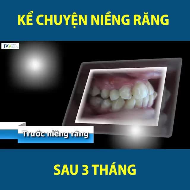 KỂ CHUYỆN NIỀNG RĂNG SAU 3 THÁNG - QUÁ TRÌNH, CẢM GIÁC, HIỆU QUẢ...