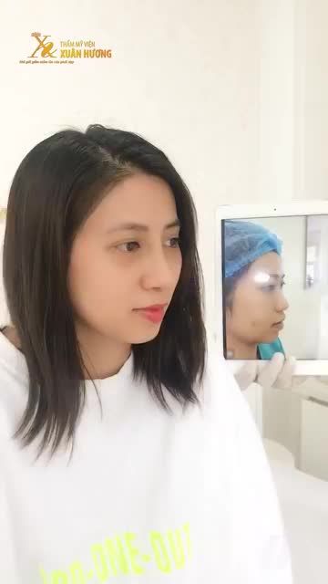 MŨI CAO THON, DÁNG MỀM MẠI TỰ NHIÊN CHỈ SAU 10 NGÀY NÂNG MŨI ERGONOMIC