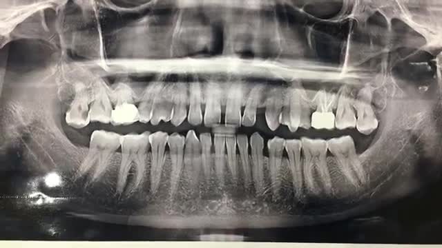 Nhổ răng khôn số 18 28 mọc trồi gây đau nhức cho chú Tâm