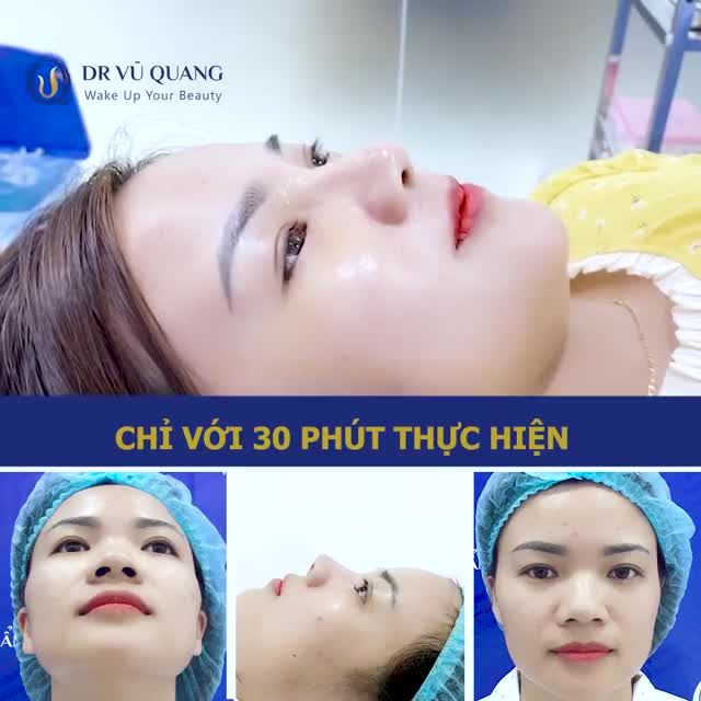 Tái khám sau 7 ngày nâng mũi SOFTLINE - " Chị thấy hài lòng" Khách hàng chia sẻ.