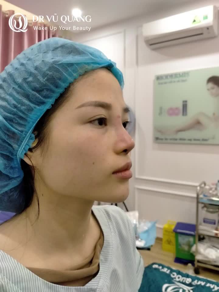 Lột xác nhan sắc cùng dáng mũi Softline!!