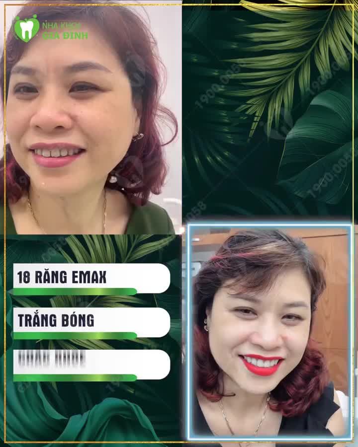 TÁI SINH NỤ CƯỜI VỚI THẨM MỸ RĂNG SỨ TẠI NHA KHOA GIA ĐÌNH