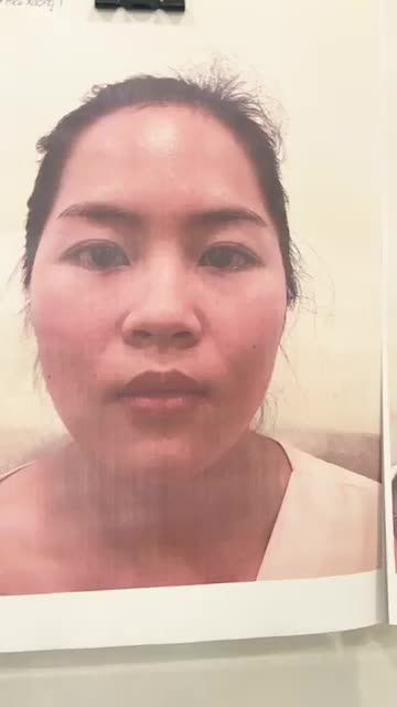 Livestream khách hàng sóng mũi thấp, đầu mũi ngắn hếch, cánh mũi bè, xương gồ bên trái.