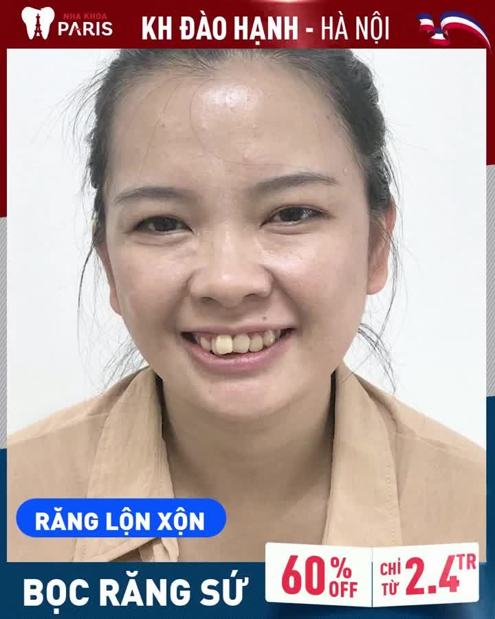 Răng Khấp Khểnh| Cười Hở Lợi| Mất Thẩm Mỹ