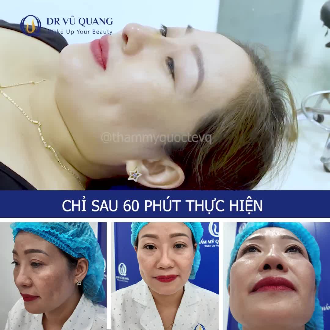 BÁC SĨ VŨ QUANG SỬA MŨI CÓ ĐẸP KHÔNG ?