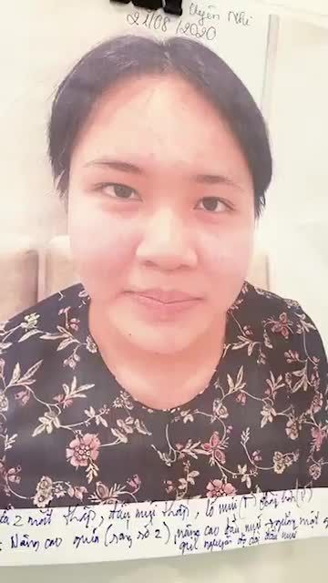 Livestream khách hàng sóng mũi thấp, đầu mũi ngắn , 2 cánh mũi bè.