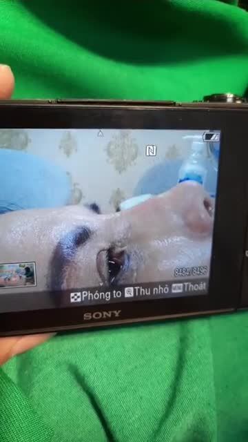 NÂNG MŨI BÁN CẤU TRÚC SỤN TAI