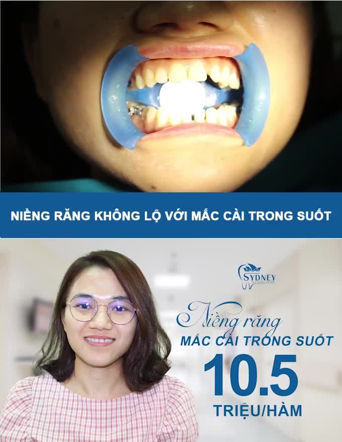 XU THẾ NIỀNG RĂNG THẾ HỆ MỚI